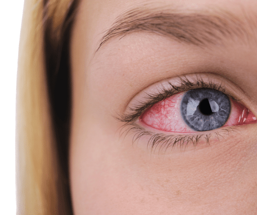 كل ما تحتاج معرفته حول جفاف العين، الأعراض والعلاج